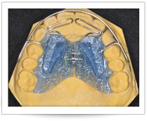 apparecchio ortodontico Planas alette laterali