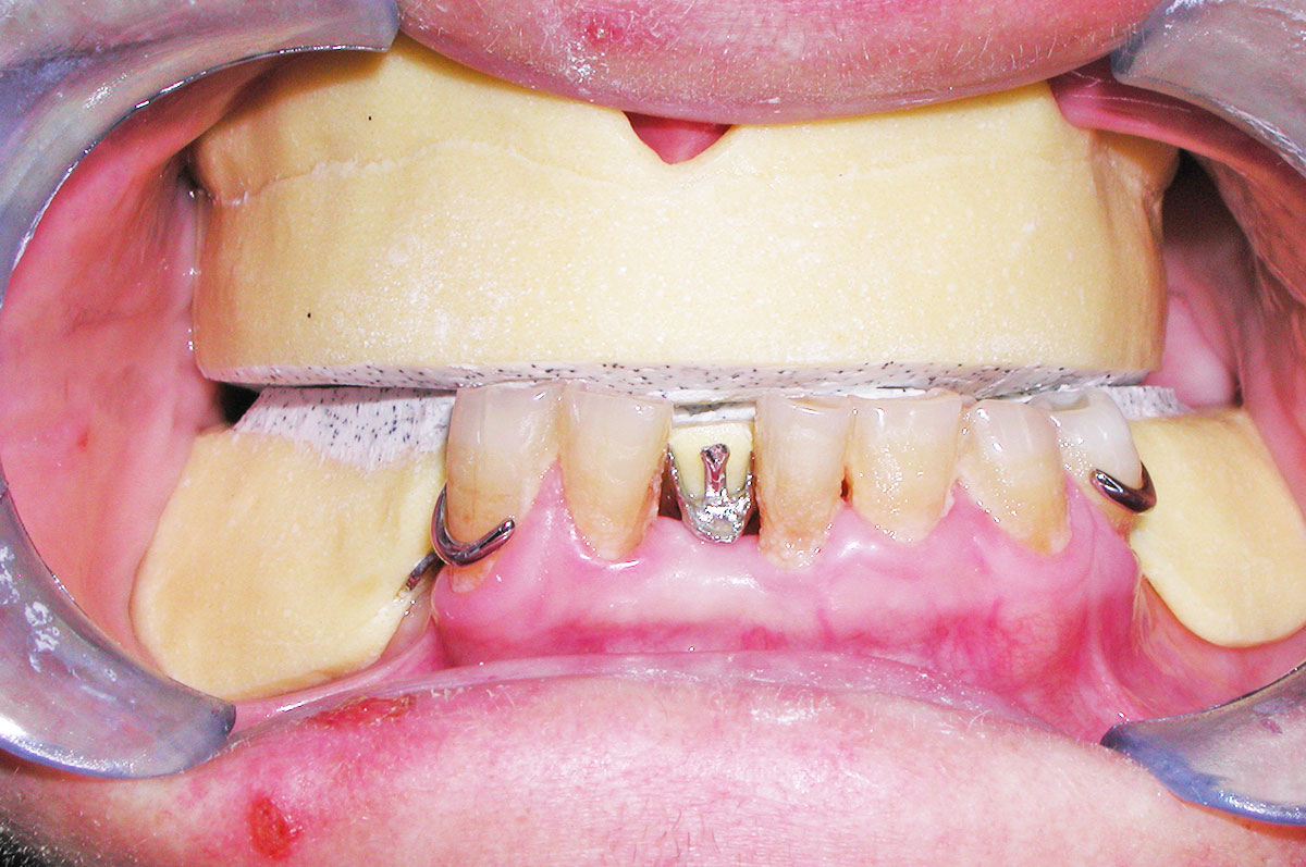 Protesi dentarie mobili e fisse