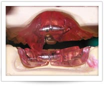 apparecchio ortodontico Planas monolaterale