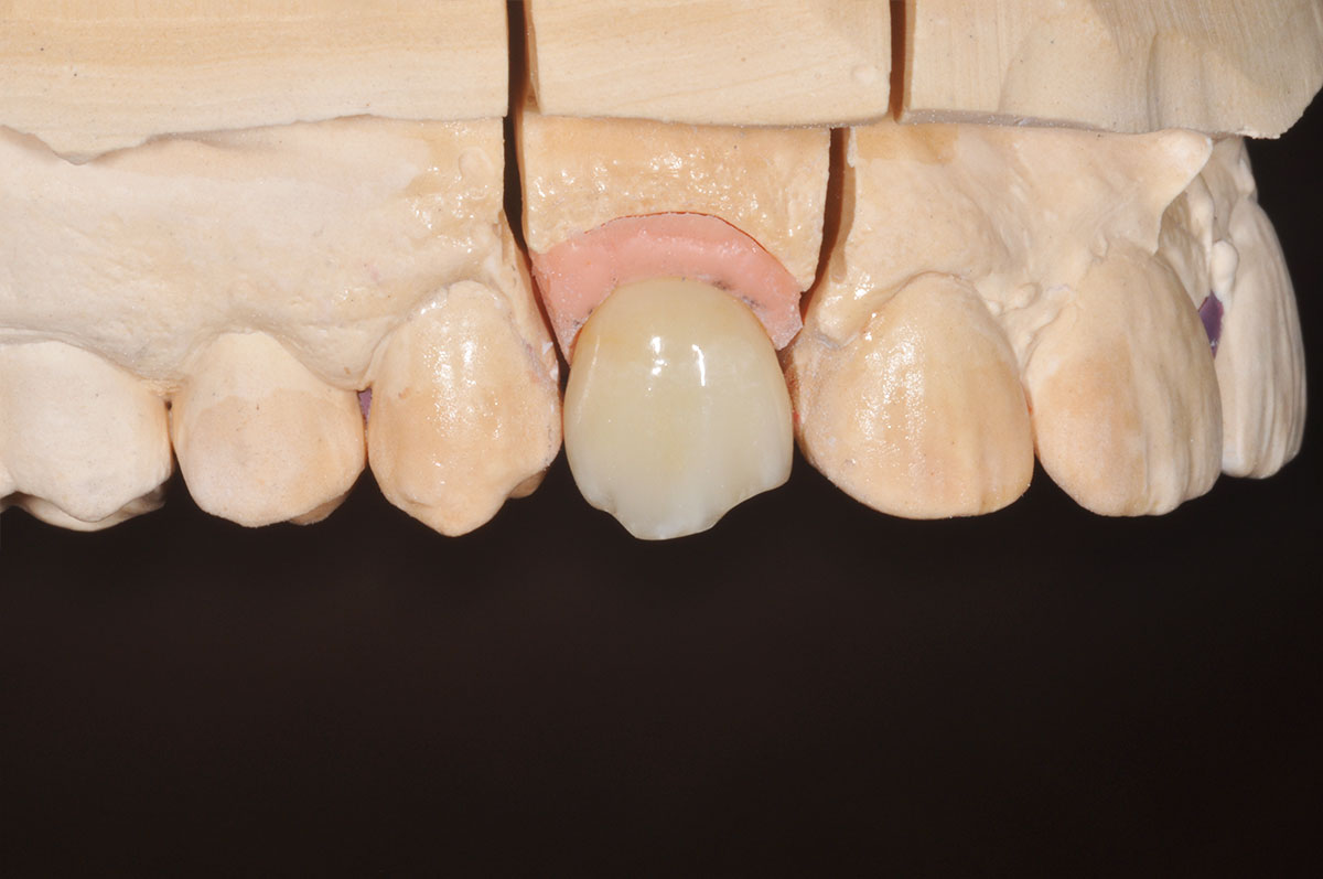 Protesi fissa denti