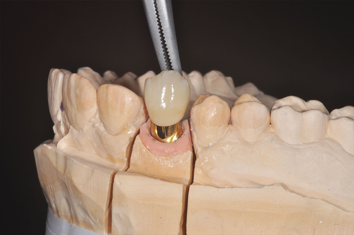 Protesi dentarie fissa